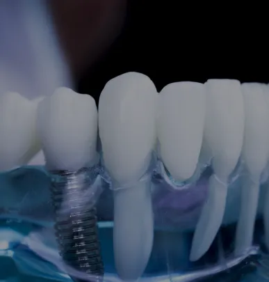 Dental Implants